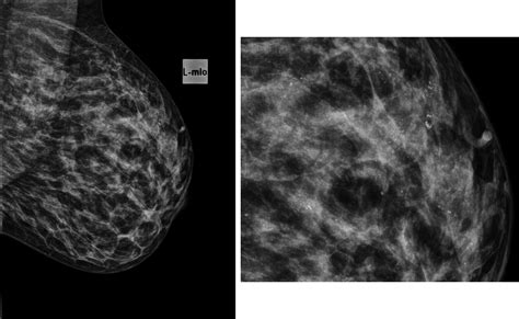 doença de paget mama - classificações de danubio fc